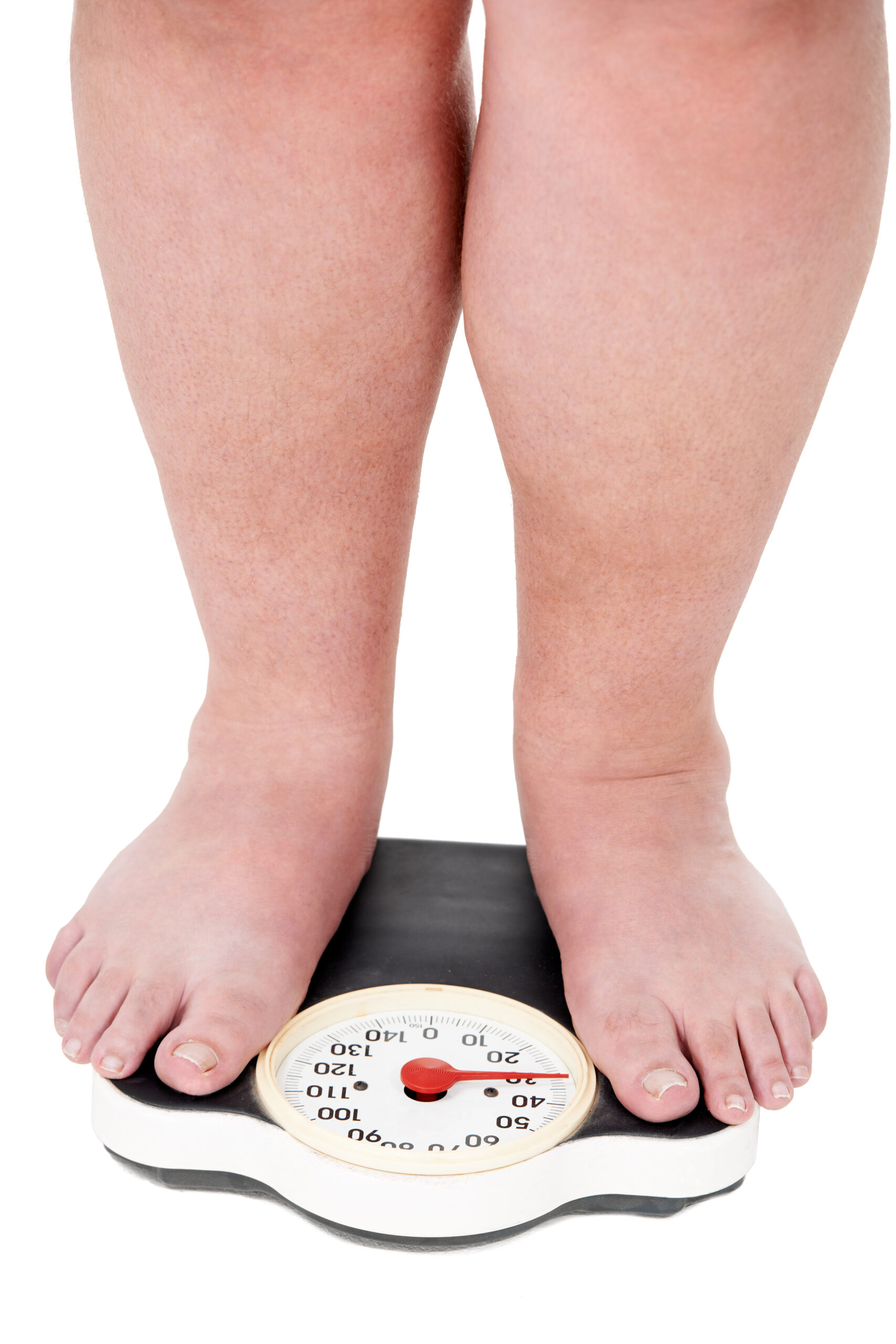 Obesity
