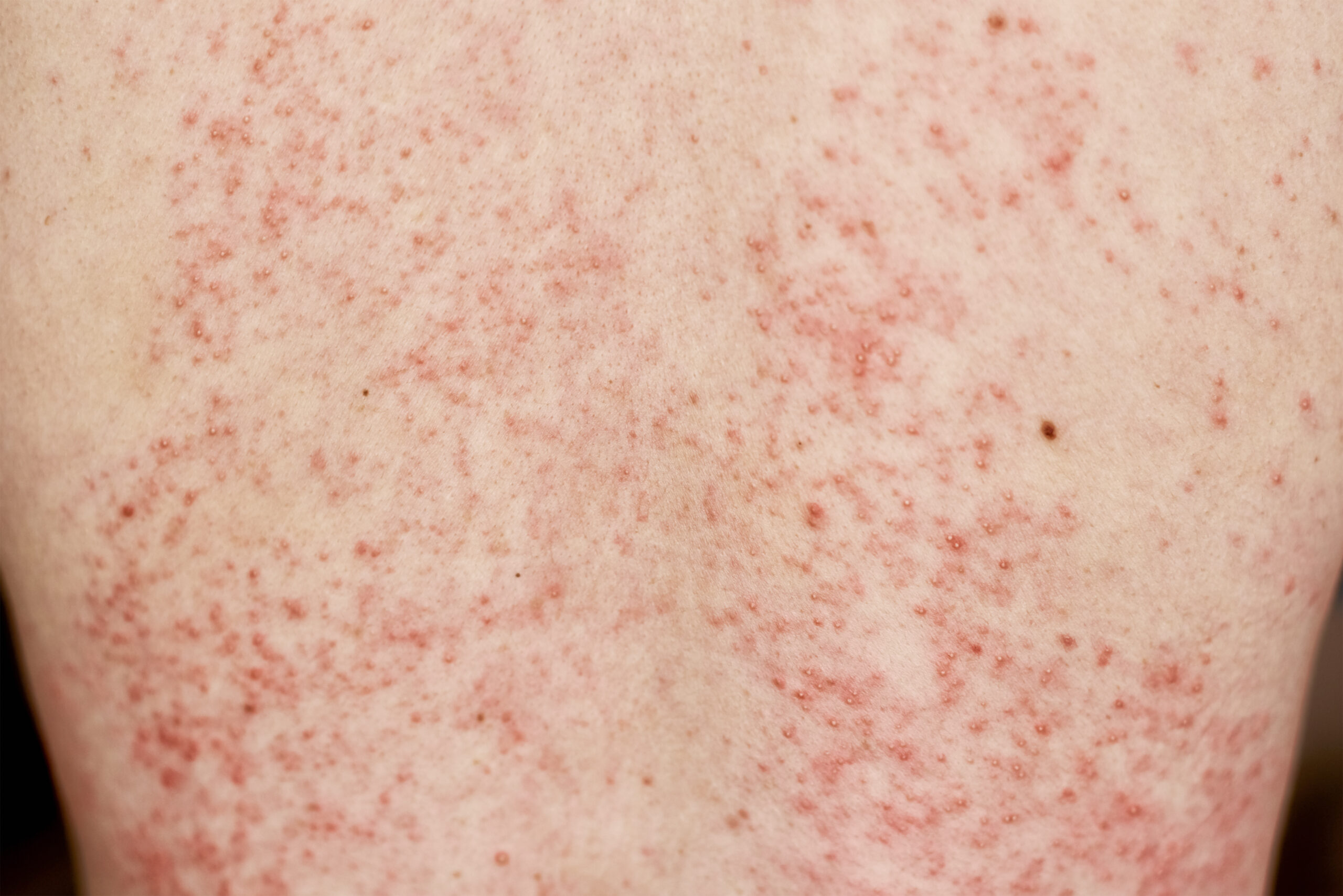 Measles